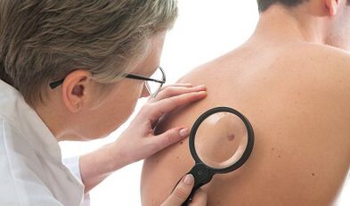 Žmogaus papilomos virusas vyrams