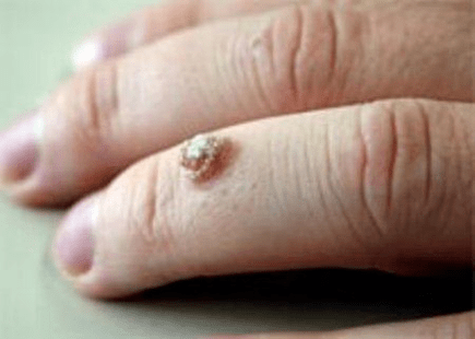 Karpos ant piršto