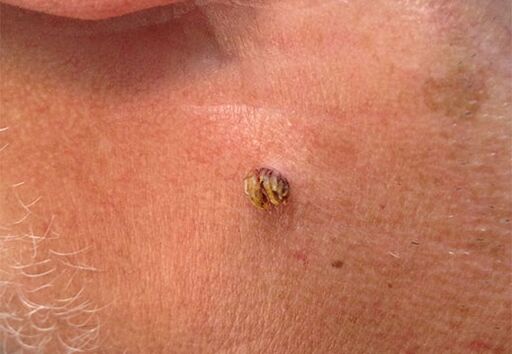 Papiloma ant kaklo