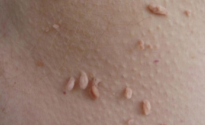 papilomų atsiradimo ant žmogaus kūno priežastys