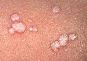 vulgarios papilomos ant žmogaus kūno