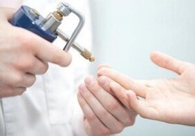 Šiuolaikiniai papilomų pašalinimo metodai