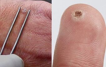 papilomų simptomai ant žmogaus kūno